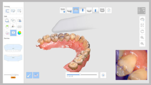 skanowanie-cyfrowe-zębów-protetyka-3d