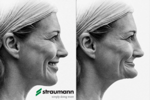implanty-stomatologiczne-Straumann