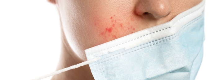 Maskne – trądzik maseczkowy i inne kłopoty Szczecin Dom Lekarski