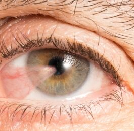 skrzydlik oka co to jest i jak go leczyć